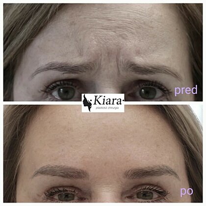 Botox-Anwendung