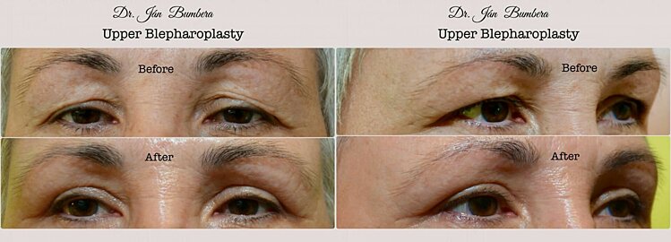Obere Blepharoplastik